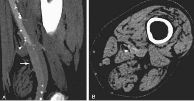 Сагитальное (А) и осевое (В) изображения при КТ-ангиографии показывают окклюзию левой поверхностной бедренной артерии (указана стрелками)
