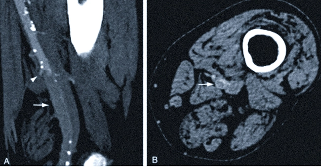 Сагитальное (А) и осевое (В) изображения при КТ-ангиографии показывают окклюзию левой поверхностной бедренной артерии (указана стрелками)
