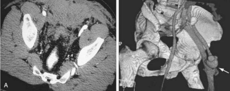Артериовенозная фистула между бедренной артерией и бедренной веной на КТ-ангиографии артерий нижних конечностей (указана стрелкой)
