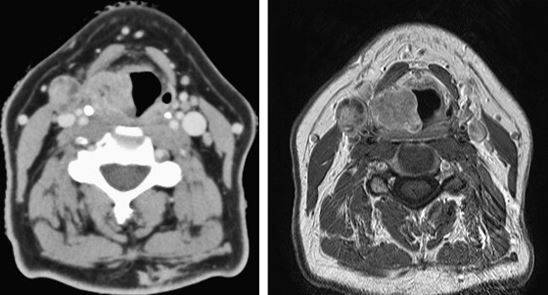 Рак правой голосовой складки на томограмме. Слева КТ, справа МРТ. Один и тот же пациент.