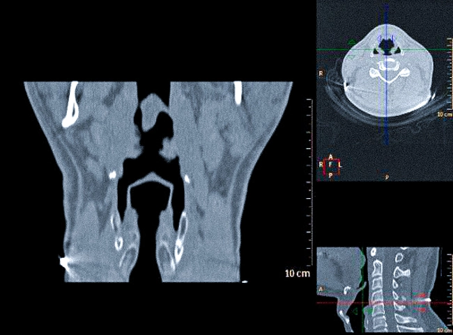 КТ гортани в трех проекциях
