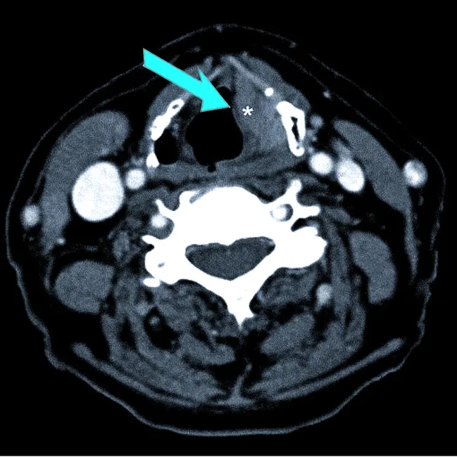 Опухоль гортани (маркирована звездочкой) в области левой голосовой связки (указана стрелкой) на компьютерной томограмме