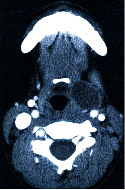 Киста щитовидно-язычного протока на компьютерной томограмме