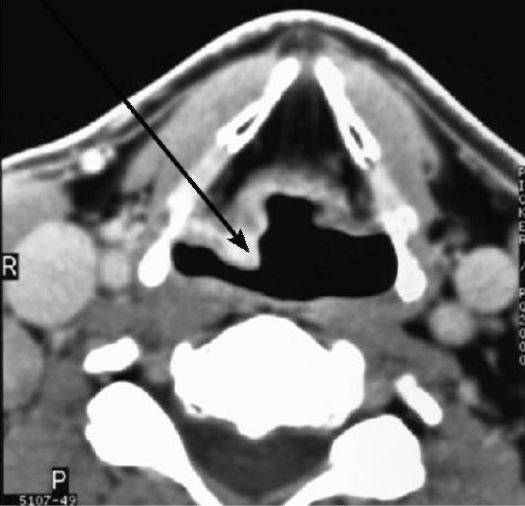 Рак гортани на компьютерной томограмме. В зоне правого грушевидного синуса стрелкой указана опухоль, отличающаяся от соседних тканей более плотной структурой.