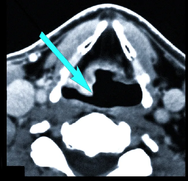 Рак гортани на компьютерной томограмме. В зоне правого грушевидного синуса стрелкой указана опухоль, отличающаяся от соседних тканей более плотной структурой.