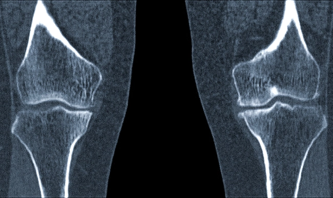 Артроз коленного сустава фото снимков томографии