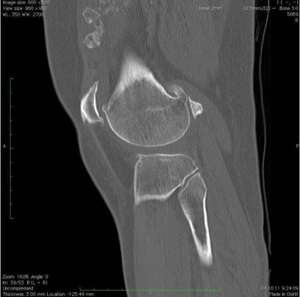 Фото КТ снимков - Хондроматоз коленного сустава