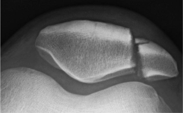 Перелом надколенника (коленной чашечки) на КТ