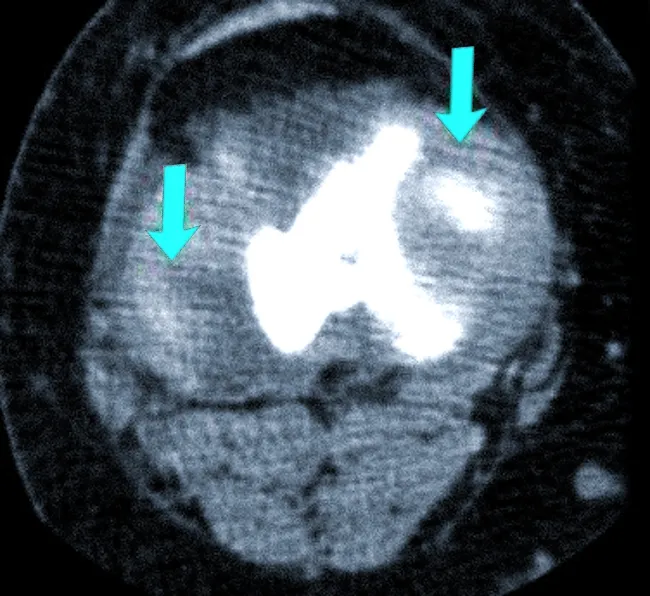 КТ мягких тканей колена: стрелки указывают на места, где расположены нечетко видимые мениски