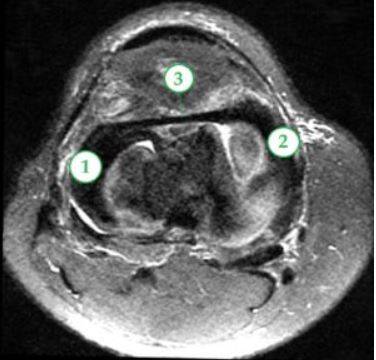 МРТ мягких тканей коленного сустава: 1 и 2 - мениски латеральный, медиальный, 3 – межменисковая связка