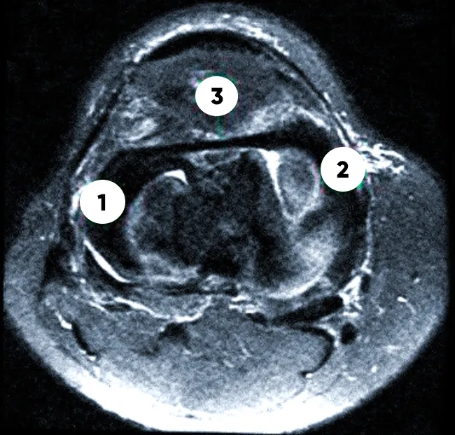 МРТ мягких тканей коленного сустава: 1 и 2 - мениски латеральный, медиальный, 3 – межменисковая связка