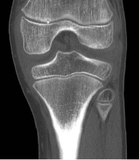 МСКТ коленного сустава (коронарная проекция)