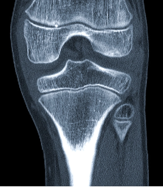 МСКТ коленного сустава (коронарная проекция)