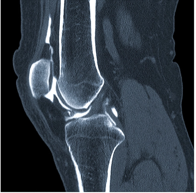 Компьютерная томограмма коленного сустава (сагиттальная проекция)