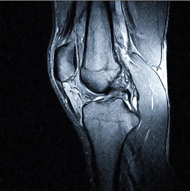 МРТ коленного сустава (сагиттальная проекция)