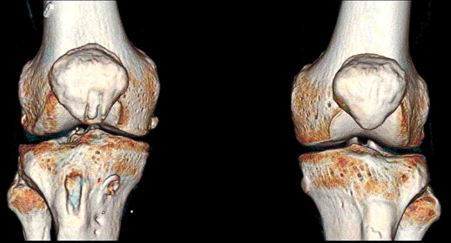 КТ коленных суставов - фотография