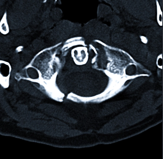 Переломы обеих дуг атланта на компьютерной томограмме