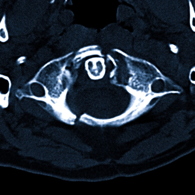 Что показывает КТ краниовертебрального перехода