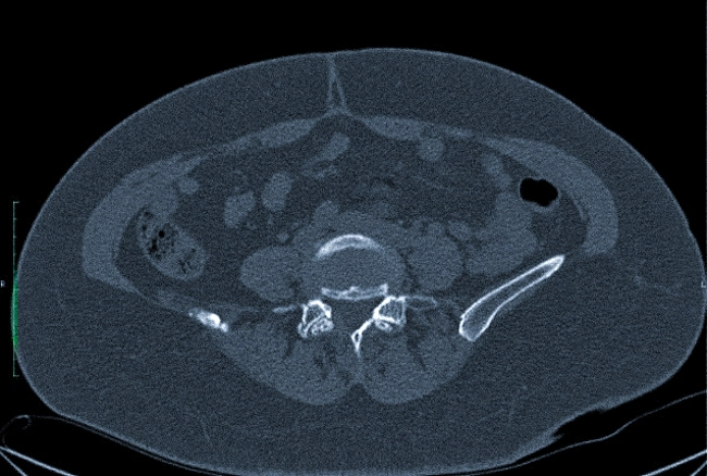 Стрессовый вертикальный перелом правой боковой массы крестца на компьютерной томограмме