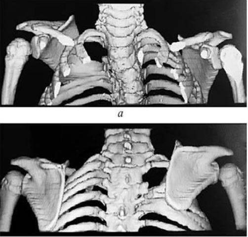 Аномальное положение левой лопатки на КТ при 3D-реконструкции: а - вид спереди, б- вид сзади