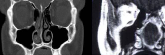 КТ (справа) и МРТ (слева) носовых пазух в коронарной проекции - фото