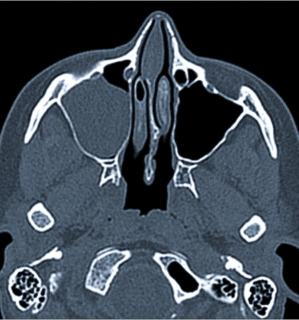 КТ пазух носа фото