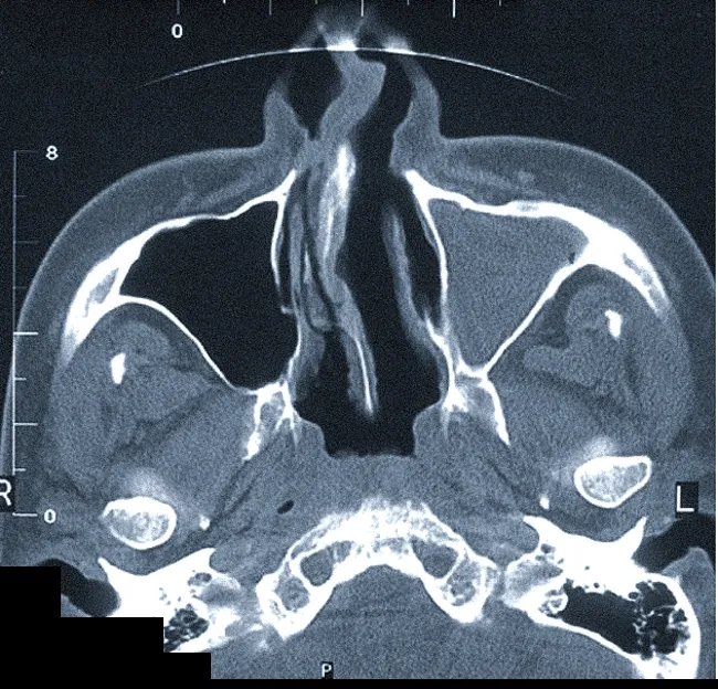 Тотальное заполнение жидкостью (кровью?) левой верхнечелюстной пазухи, повреждение носовой перегородки на компьютерной томограмме