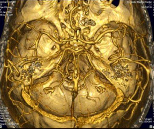 3D-КТ-ангиография сосудов головного мозга