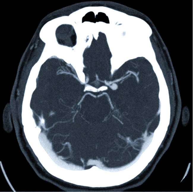 На компьютерной томограмме: аневризма левой внутренней сонной артерии