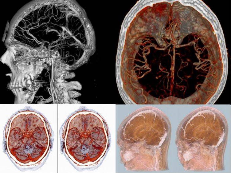 КТ-ангиография головного мозга (3D-реконструкция)