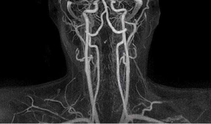 КТ-ангиограмма сосудов головного мозга и шеи