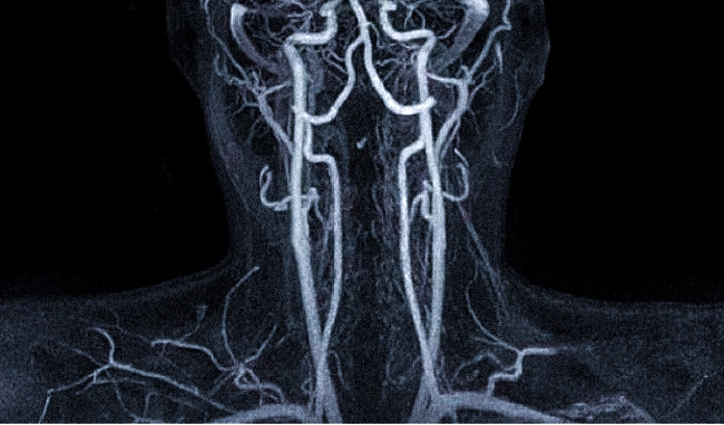 КТ-ангиограмма сосудов головного мозга и шеи