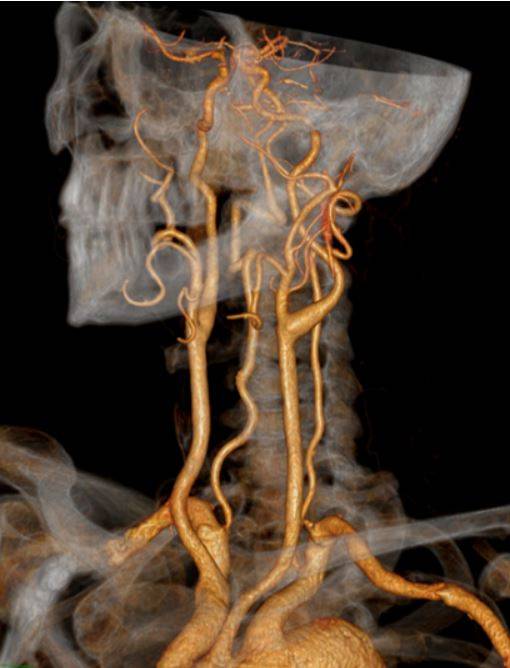Компьютерная томография сосудов головы и шеи - объемная реконструкция