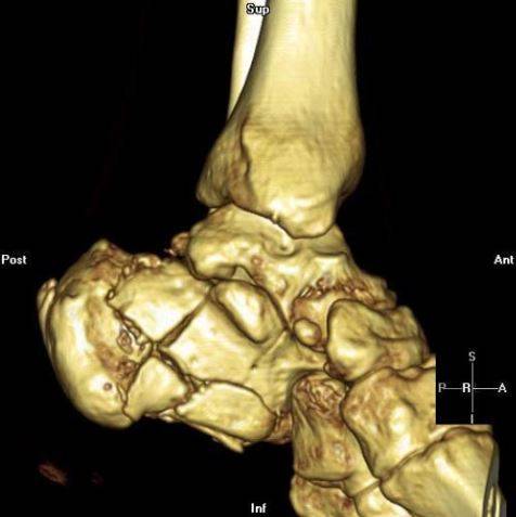 Перелом пяточной кости на КТ стопы, 3D-изображение
