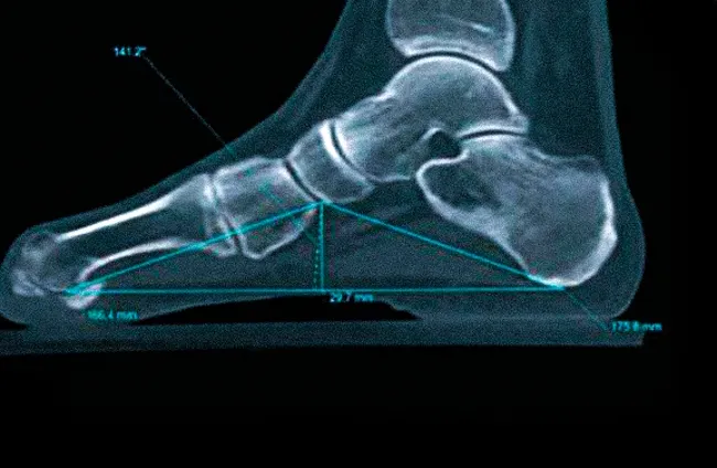 Измерение угла и высоты продольного свода стопы при МСКТ