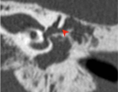 Хроническое воспаление среднего уха с холестеатомой: коронарная КТ показывает боковой свищ полукруглого канала (стрелка), вызванный эрозией кости из-за роста новообразования