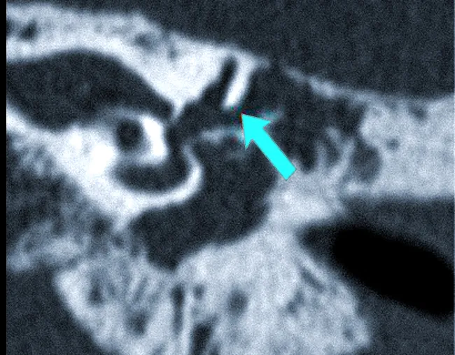 Хроническое воспаление среднего уха с холестеатомой: коронарная КТ показывает боковой свищ полукруглого канала (стрелка), вызванный эрозией кости из-за роста новообразования