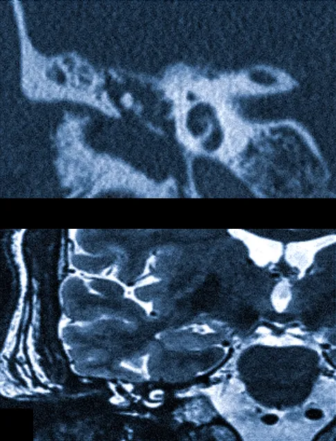 Что показывает КТ уха? КТ или МРТ что лучше? Подготовка, показания и противопоказания