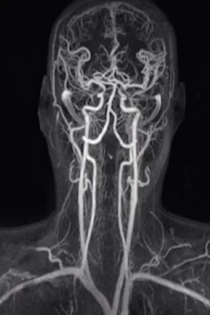 МР-ангиография сосудов головы и шеи
