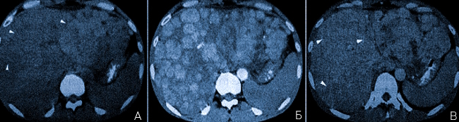 Цирроз печени на КТ с контрастом