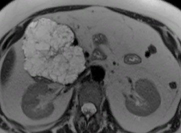 МР-томограмма: мультикистозная неоплазия в железе