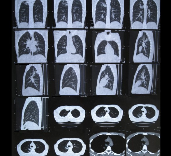 Компьютерная томография органов грудной клетки: печать снимков на пленке