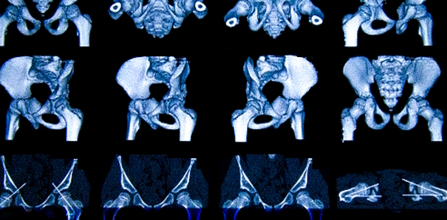 Компьютерная томография тазобедренных суставов