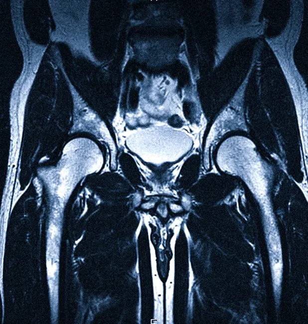 МРТ тазобедренных суставов