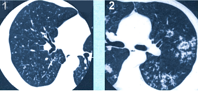 Гематогенный (1) и лимфогенный (2) туберкулез на КТ