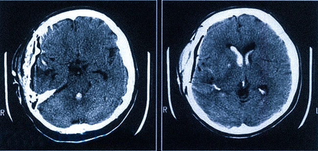 Кровоизлияние в желудочки мозга на КТ