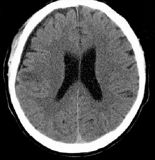  Последствия травмы головного мозга на КТ