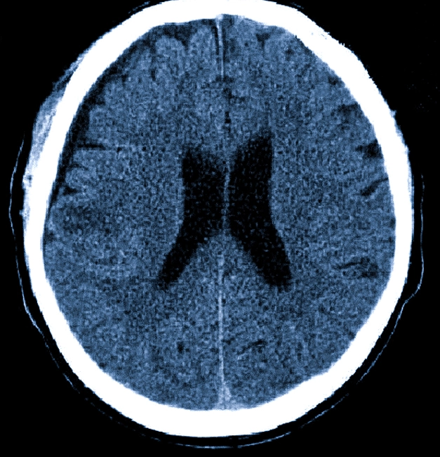  Последствия травмы головного мозга на КТ