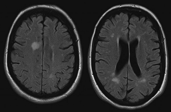 Энцефалопатия на МРТ головного мозга