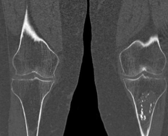 Энхондрома левой большеберцовой кости, случайно выявленная при КТ
